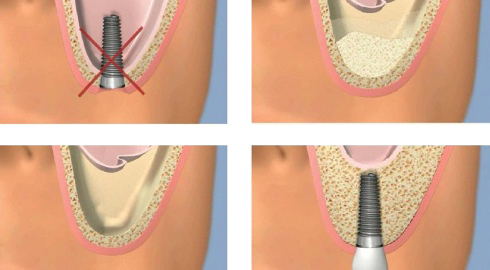 Sinus Lifting